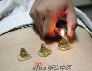灸法的種類  你知道多少？